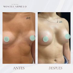 Clínica Montecarmelo - Aumento de pecho