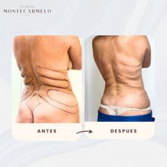 Clínica Montecarmelo - Liposucción
