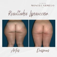 Clínica Montecarmelo - Liposucción