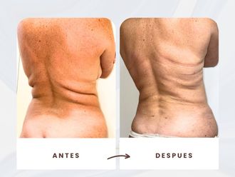 Liposucción antes y después - 875879