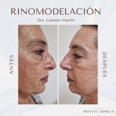 Clínica Montecarmelo - Rinomodelación