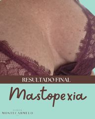 Clínica Montecarmelo - Mastopexia