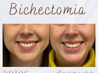 Bichectomía antes y después - 875884