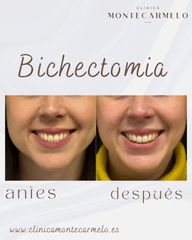 Clínica Montecarmelo - Bichectomia