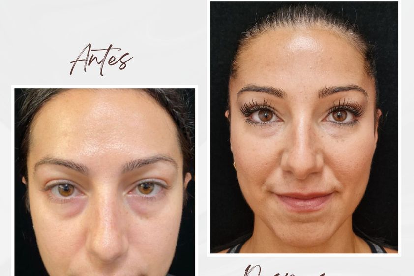 Rejuvenecimiento facial antes y después - 875885
