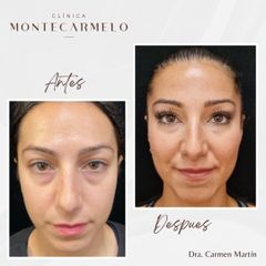 Clínica Montecarmelo - Rejuvenecimiento