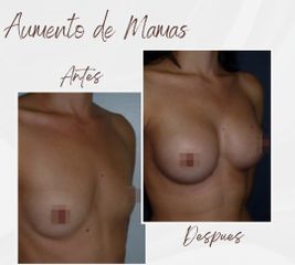 Clínica Montecarmelo - Aumento de pecho