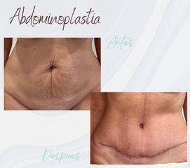 Clínica Montecarmelo - Abdominoplastia