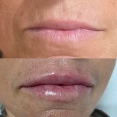 aumento e hidratacion de labios - Clínica Montecarmelo