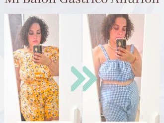 Balón gástrico antes y después - 875893