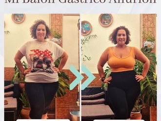 Balón gástrico antes y después - 875895