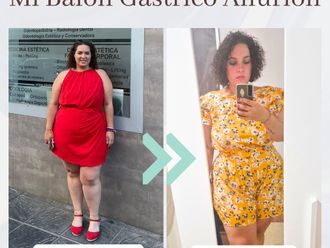 Balón gástrico antes y después - 875896