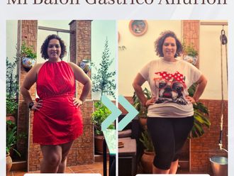 Balón gástrico antes y después - 875897