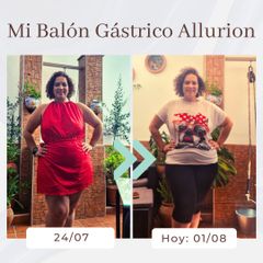 Clínica Montecarmelo - Balón gástrico
