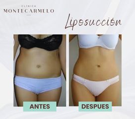 Clínica Montecarmelo - Liposucción