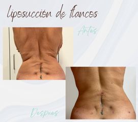 Clínica Montecarmelo - Liposucción