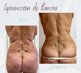 Clínica Montecarmelo - Liposucción