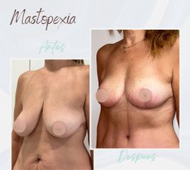 Clínica Montecarmelo - Mastopexia
