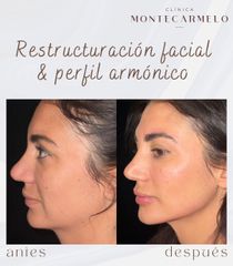 Clínica Montecarmelo - Rejuvenecimiento