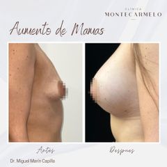 Clínica Montecarmelo - Aumento de Mamas