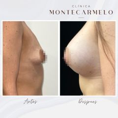 Clínica Montecarmelo - Aumento de Mamas