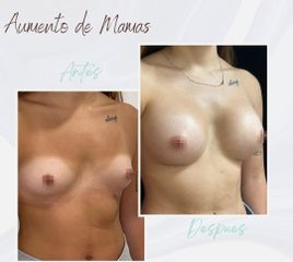 Clínica Montecarmelo - Aumento de Mamas