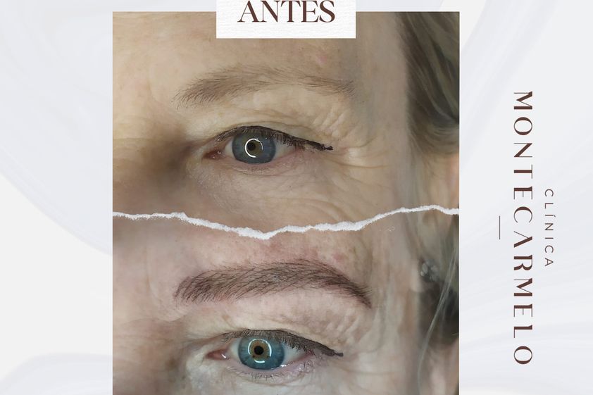 Micropigmentación antes y después - 876112