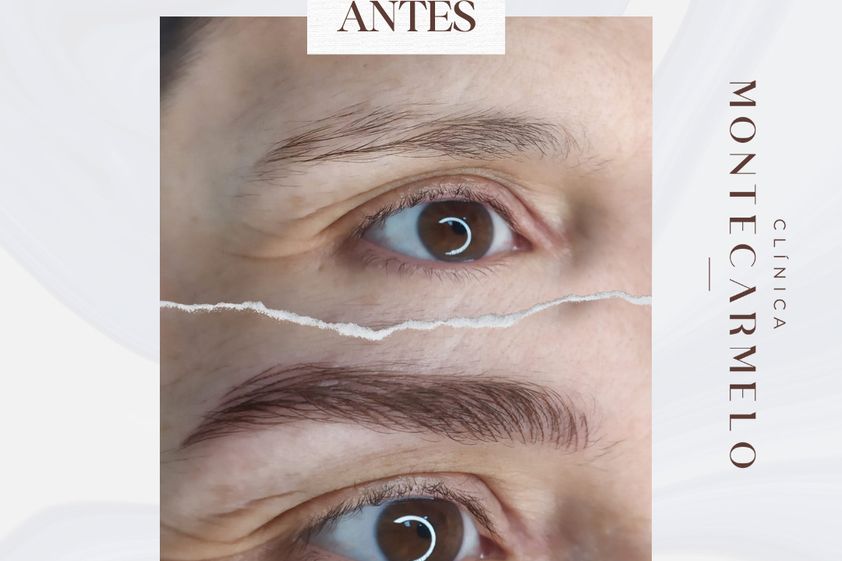 Micropigmentación antes y después - 876114