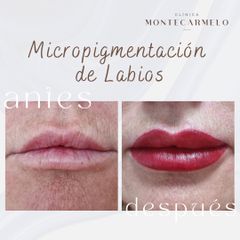 Clínica Montecarmelo - Micropigmentación de labios