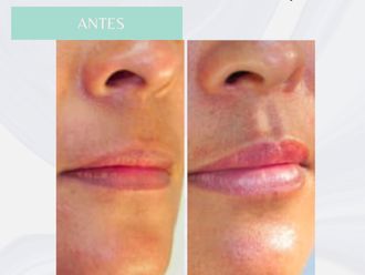 Aumento labios antes y después - 876116
