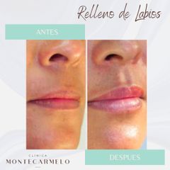 Clínica Montecarmelo - Relleno de Labios
