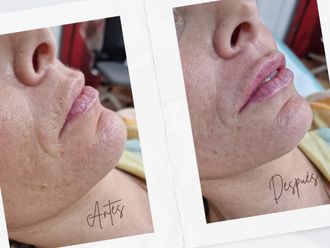 Aumento labios antes y después - 876117