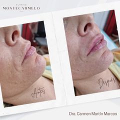 Clínica Montecarmelo - Relleno Labios