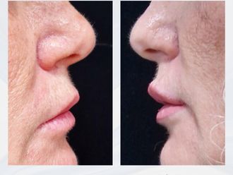 Aumento labios antes y después - 876118
