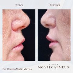 Clínica Montecarmelo - Relleno Labios