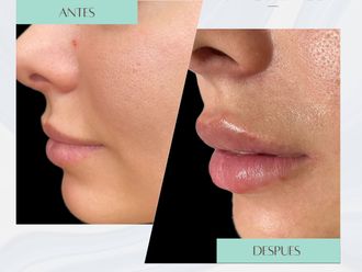 Aumento labios antes y después - 876119