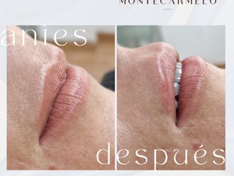 Aumento labios antes y después - 876120