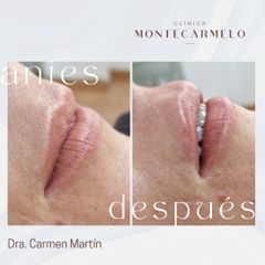 Clínica Montecarmelo - Relleno Labios
