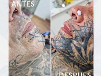 Aumento labios antes y después - 876121