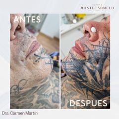Clínica Montecarmelo - Relleno Labios