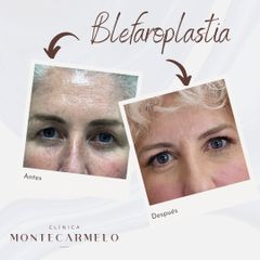 Clínica Montecarmelo - Blefaroplastia