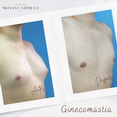Clínica Montecarmelo - Ginecomastia