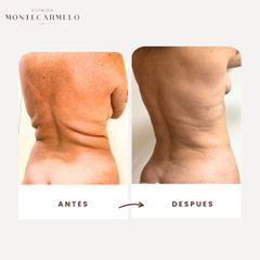 Clínica Montecarmelo - Lipo de flacos y espalda