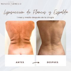 Clínica Montecarmelo - Lipo de flacos y espalda