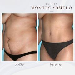 Clínica Montecarmelo - Liposucción