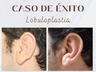 Otoplastia antes y después - 876210