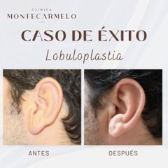 Clínica Montecarmelo - Lobuloplastia