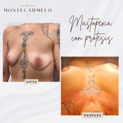 Clínica Montecarmelo - Mastopexia con prótesis