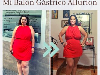 Balón gástrico antes y después - 876212