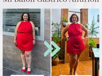 Balón gástrico antes y después - 876213